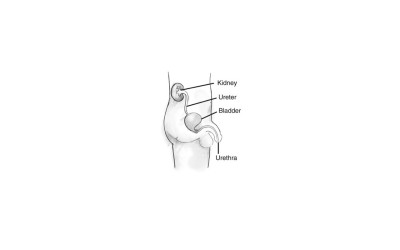 Penile Clamp for Male Urinary Incontinence