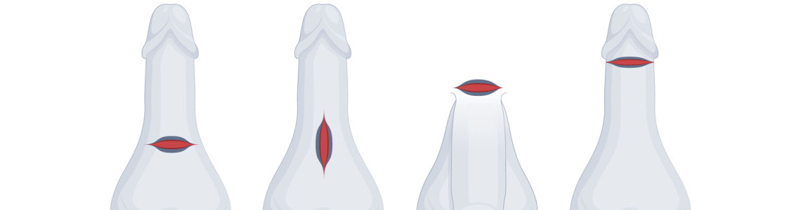 Penile Compression Devices Penile Compression Devices