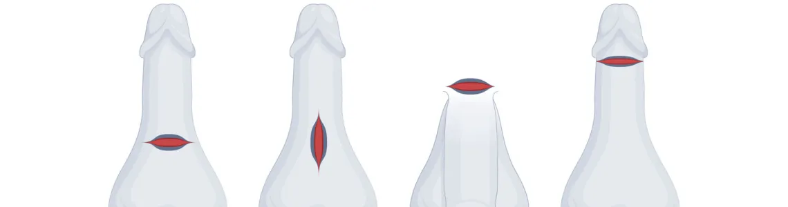 Penile Compression Devices