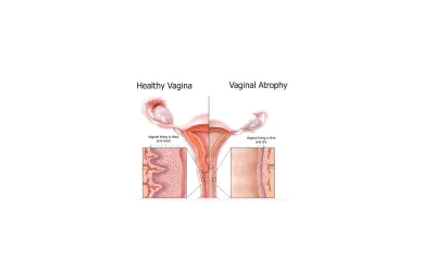 Why use dilators for atrophy