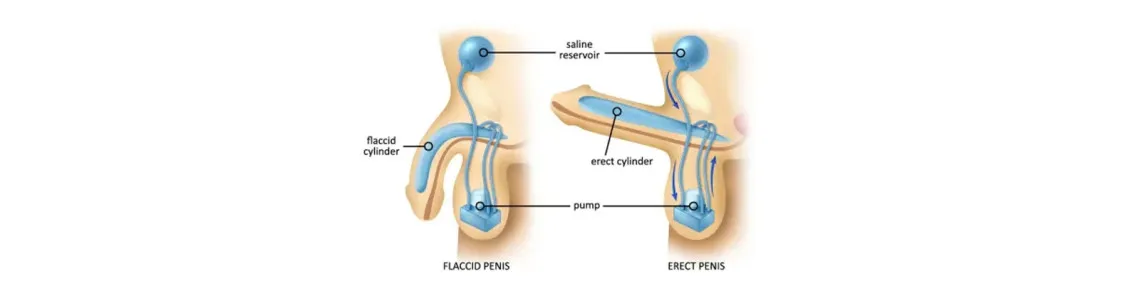 Erectile Dysfunction